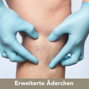 Behandlung von erweiterten Äderchen by Medaesthetics Wien