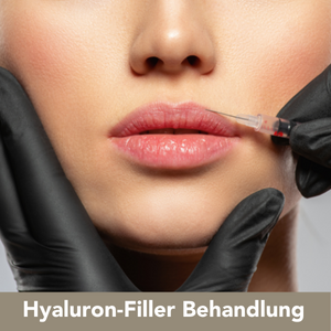 Hyaluron-Filler Behandlung - Therapie von sogenannten „statischen Falten“ benützt, d.h. zur Faltenunterspritzung, Volumenaufbau bzw. Lippenformung by Medaesthetics Wien